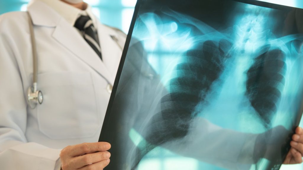 Lung cancer cases rise in Türkiye as expert urges early screening