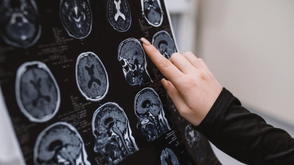 Turkish scientists lead effort to predict Alzheimer’s progression